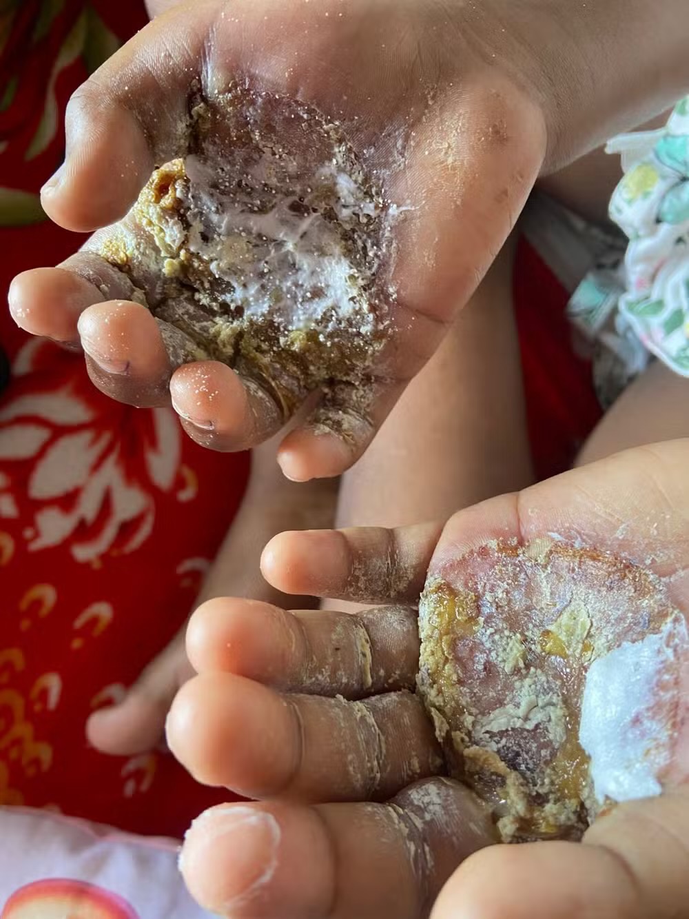 Polícia prende mãe por torturar a filha com ovo em estado de fervura em Niterói